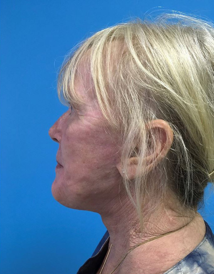 Facelift Melbourne Before & After | Patient 05 Photo 1