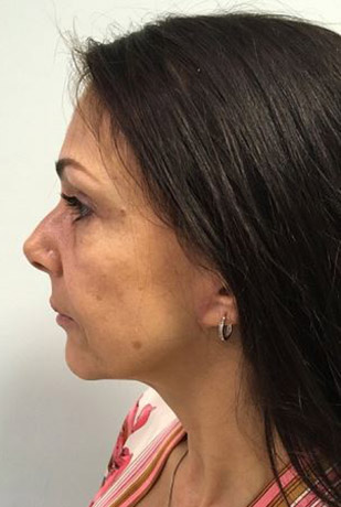 Facelift Melbourne Before & After | Patient 06 Photo 1