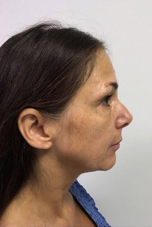 Facelift Melbourne Before & After | Patient 06 Photo 2 Thumb