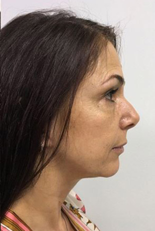 Facelift Melbourne Before & After | Patient 06 Photo 3 Thumb