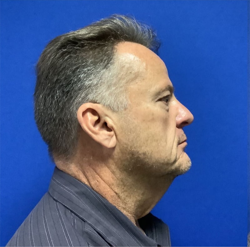 Neck Lift Melbourne Before & After | Patient 01 Photo 0