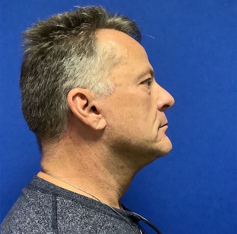 Neck Lift Melbourne Before & After | Patient 01 Photo 1