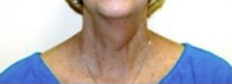 Neck Lift Melbourne Before & After | Patient 02 Photo 0 Thumb