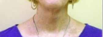 Neck Lift Melbourne Before & After | Patient 02 Photo 1 Thumb