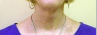 Neck Lift Melbourne Before & After | Patient 02 Photo 1