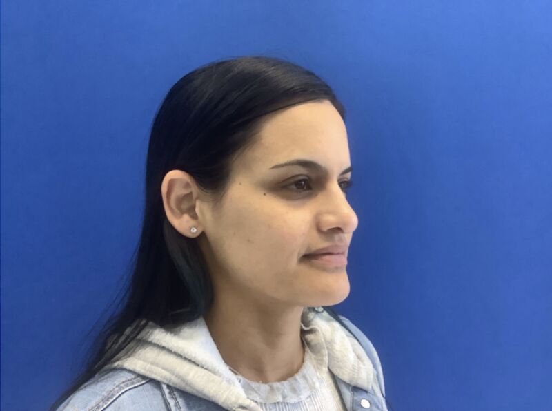 Rhinoplasty Melbourne Before & After | Patient 01 Photo 0