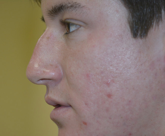 Rhinoplasty Melbourne Before & After | Patient 03 Photo 0