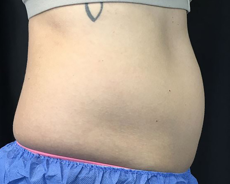 Coolsculpting Melbourne Before & After | Patient 01 Photo 2