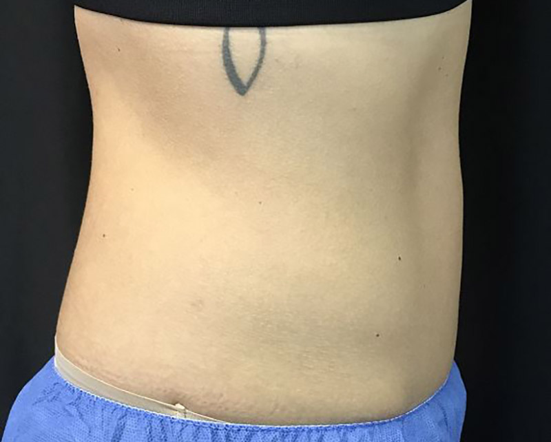 Coolsculpting Melbourne Before & After | Patient 01 Photo 3
