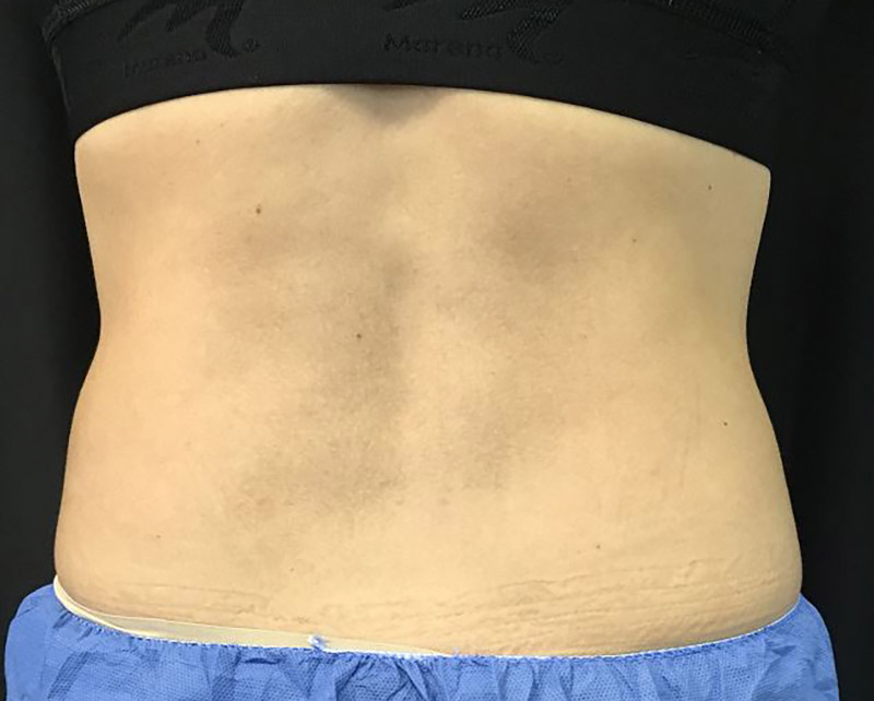 Coolsculpting Melbourne Before & After | Patient 01 Photo 5 Thumb