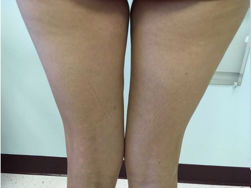 Coolsculpting Melbourne Before & After | Patient 02 Photo 0