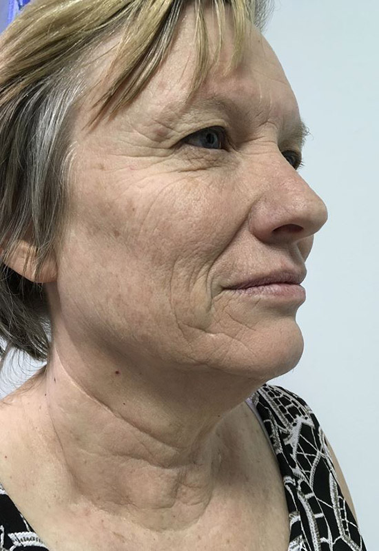 FaceTite Melbourne Before & After | Patient 01 Photo 0