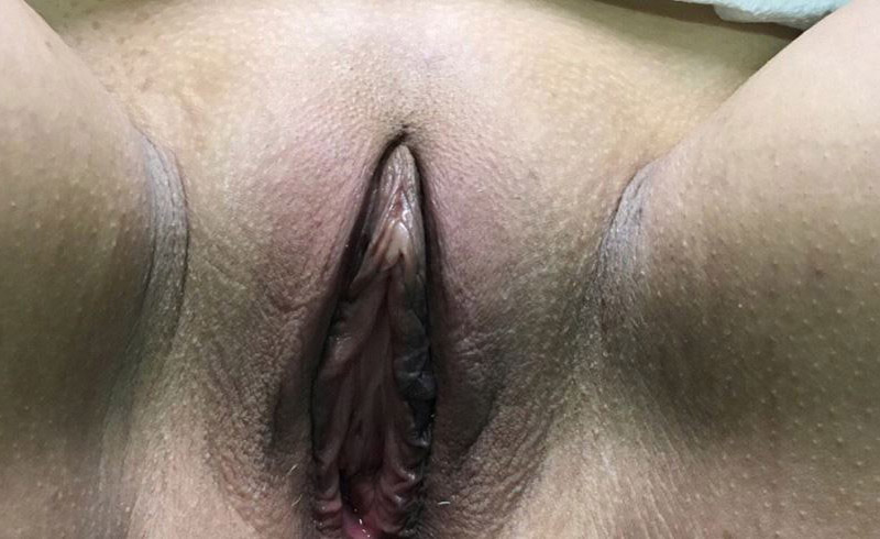 Votiva Vaginal Rejuvenation Melbourne Before & After | Patient 01 Photo 0